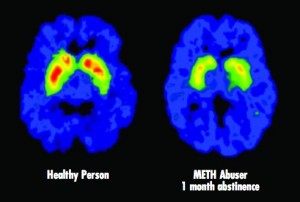 Volkow NIDA Brain Scan