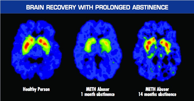 Alcoholic Brain Vs Normal Advice On Drugs From An Old Fart Coping