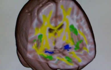 brain addiction impulse volkow brain addiction impulse volkow